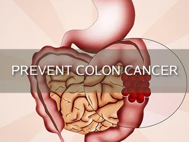 Top 12 Steps You Can Take to Prevent Colon Cancer Today! article image
